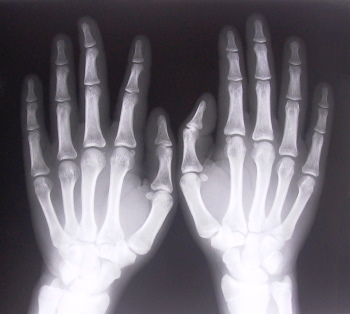 X-ray of hands