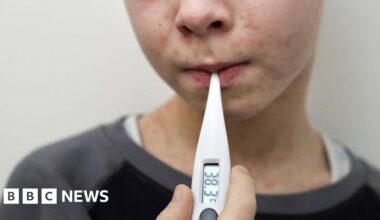 Why are measles cases rising in the UK and who can get the MMR vaccine?