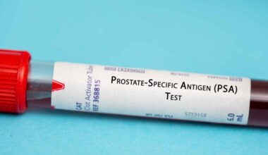 Danske forskere finder ny måde at opdage prostatakræft tidligt