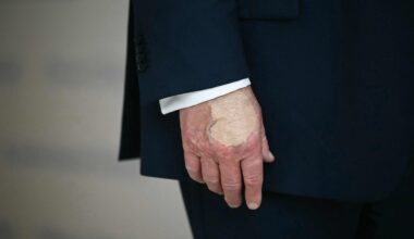 Trump health update: Why POTUS has repeated bruises on his hand. White House answers | World News