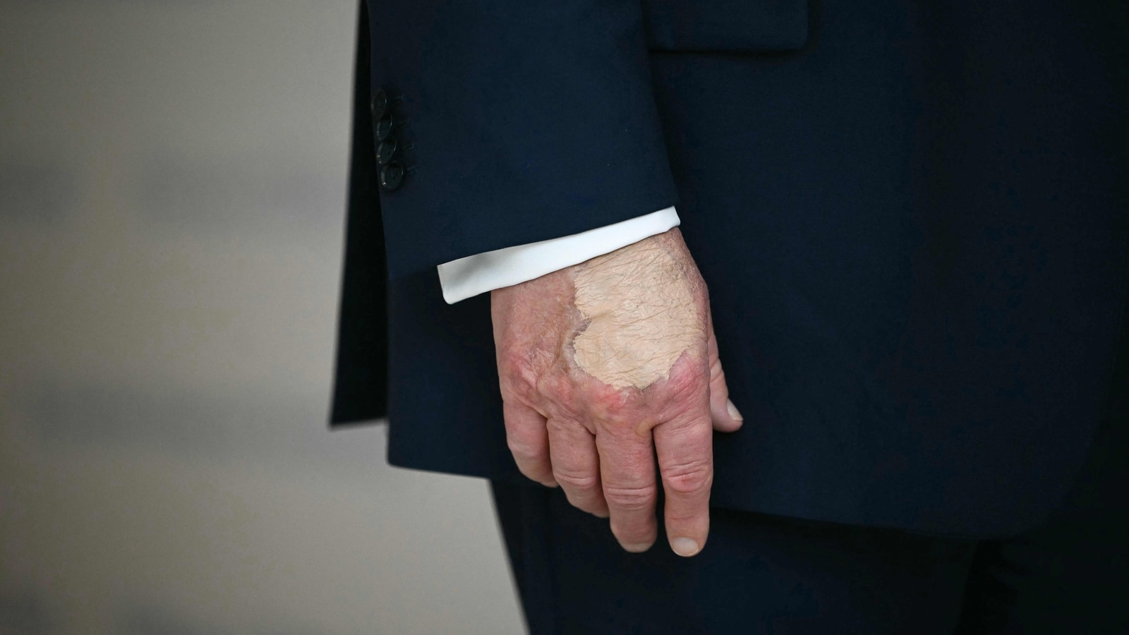 Trump health update: Why POTUS has repeated bruises on his hand. White House answers | World News