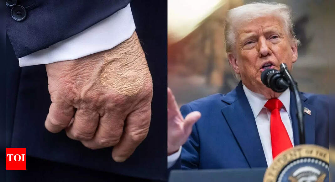 What’s going on with Donald Trump’s hands? Viral photos show large blotches of 'foundation' on POTUS' hands |