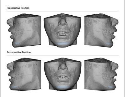 Top Los Angeles Oral and Maxillofacial Surgeon Dr. David Salehani Enhances Genioplasty and Corrective Jaw Surgery with Virtual Surgical Planning