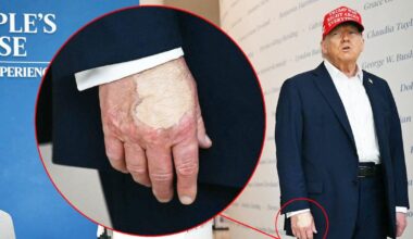 Trump, 79, Smears Right Hand In Makeup Amid Cankles Cover-Up