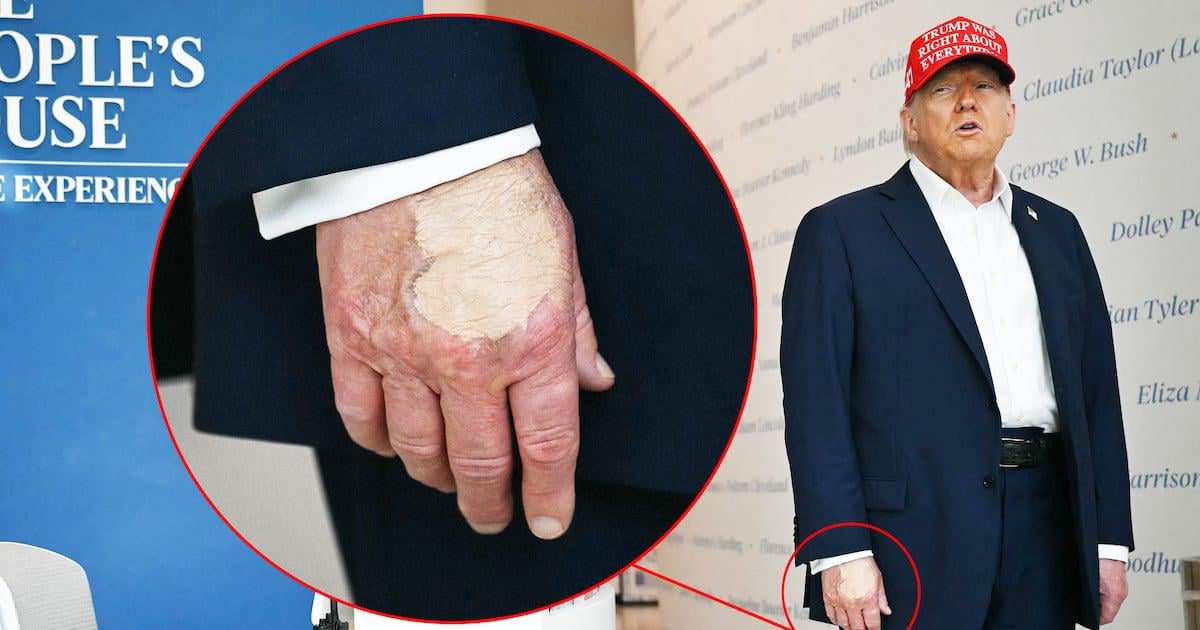 Trump, 79, Smears Right Hand In Makeup Amid Cankles Cover-Up