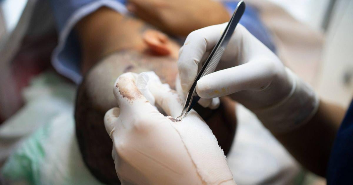 Brit dies in Turkey after hair transplant as 'homicide investigation launched'