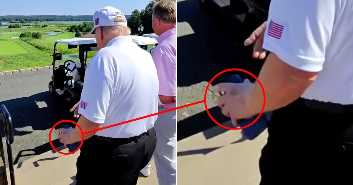 Trump, 79, Spotted With New Bruise on His Other Hand