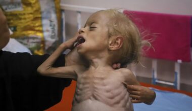 Malnourished kids arrive daily at a Gaza hospital as Netanyahu denies hunger
