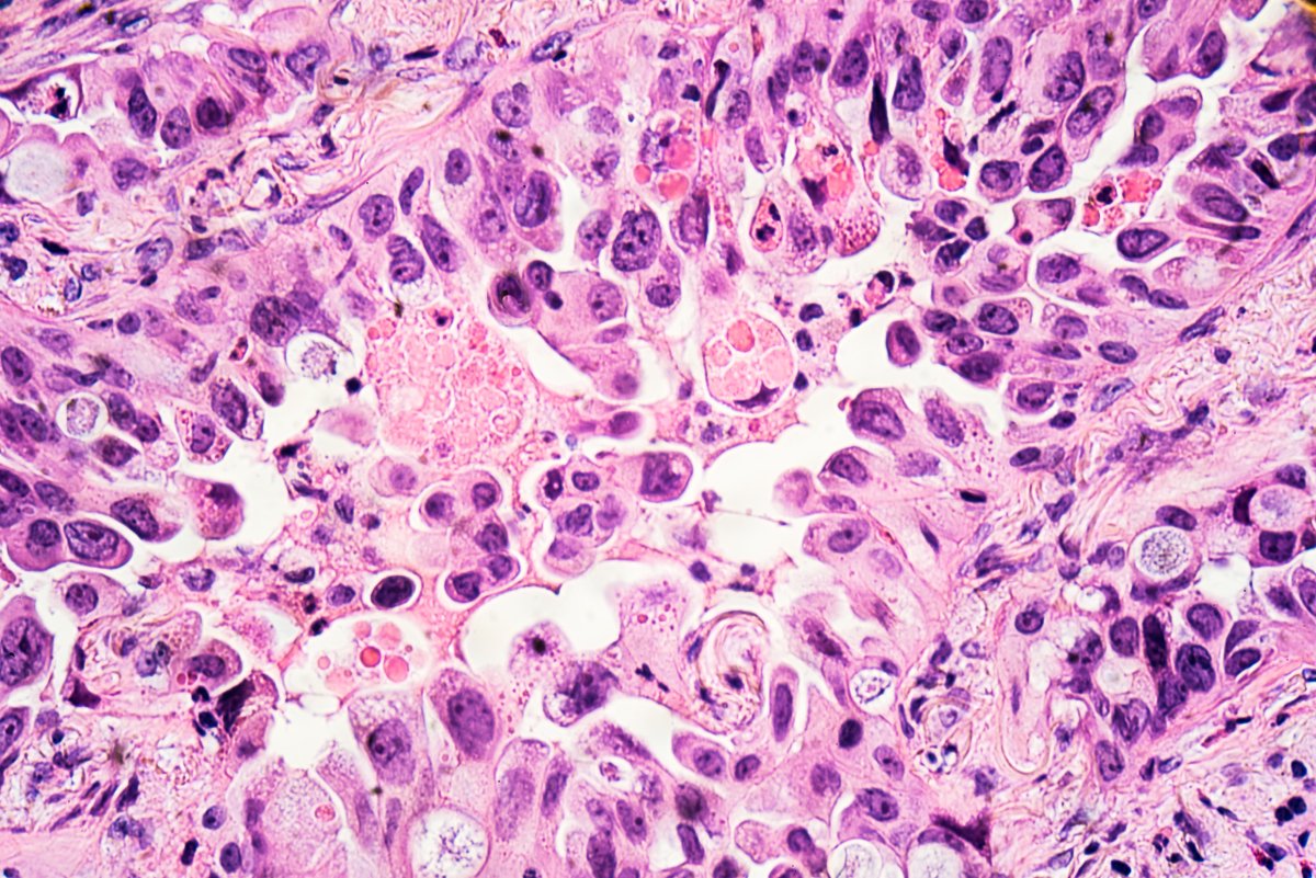 Lung Cancer Adenocarcinoma