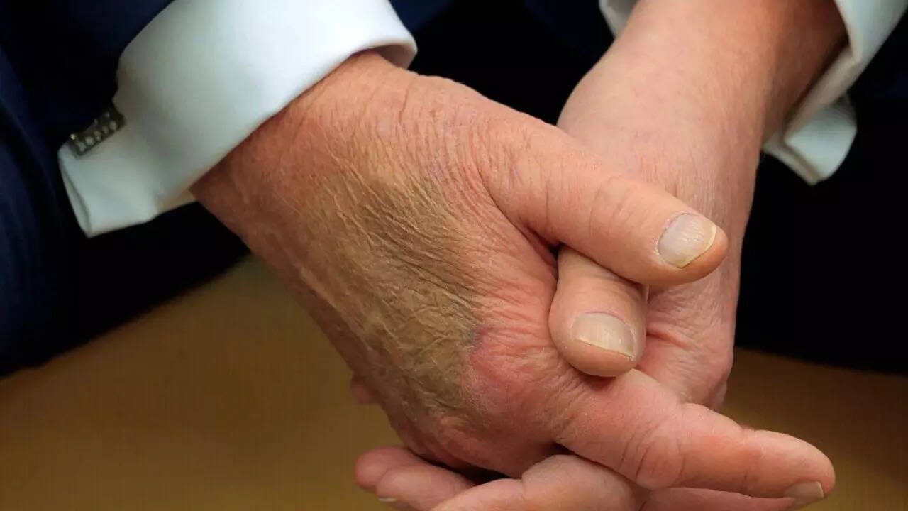 Trump hand (2)