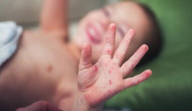 One-year-old infant dies of measles in Jerusalem