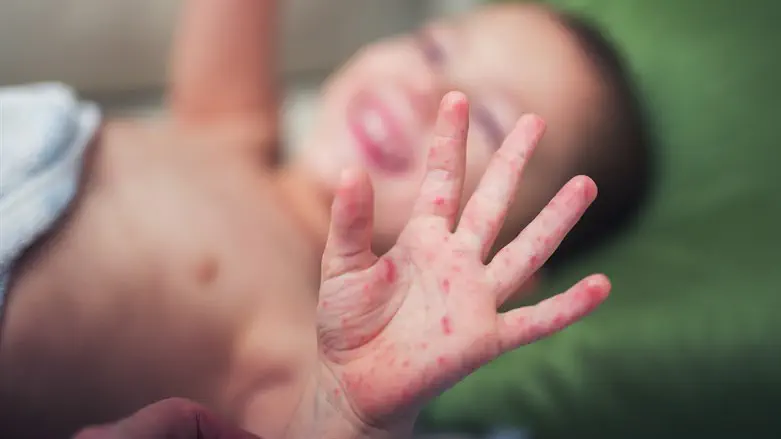 One-year-old infant dies of measles in Jerusalem