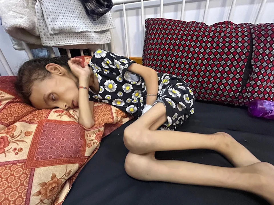 Farida Al-Ghoul, a writer and educator, took this photo of a 9-year-old girl who is severely malnourished in northern Gaza.