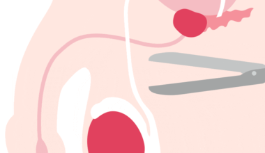 Antallet af mænd, der bliver steriliseret, er fordoblet på 10 år: 'Jeg synes, det var meget rimeligt, at det var mig, der tog den tørn'