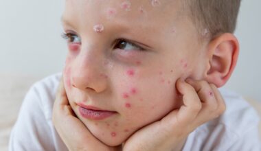 Bulgaria expands immunisation scheme with free chickenpox vaccines