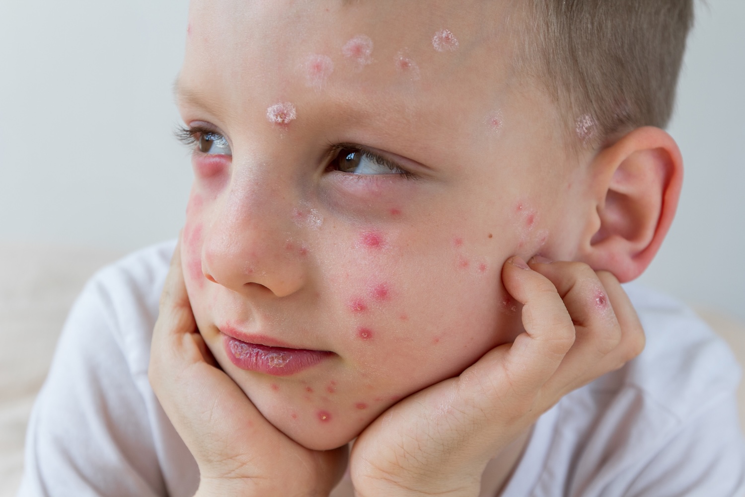 Bulgaria expands immunisation scheme with free chickenpox vaccines