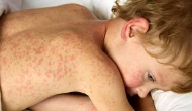 Second child dies of measles in Jerusalem within a week