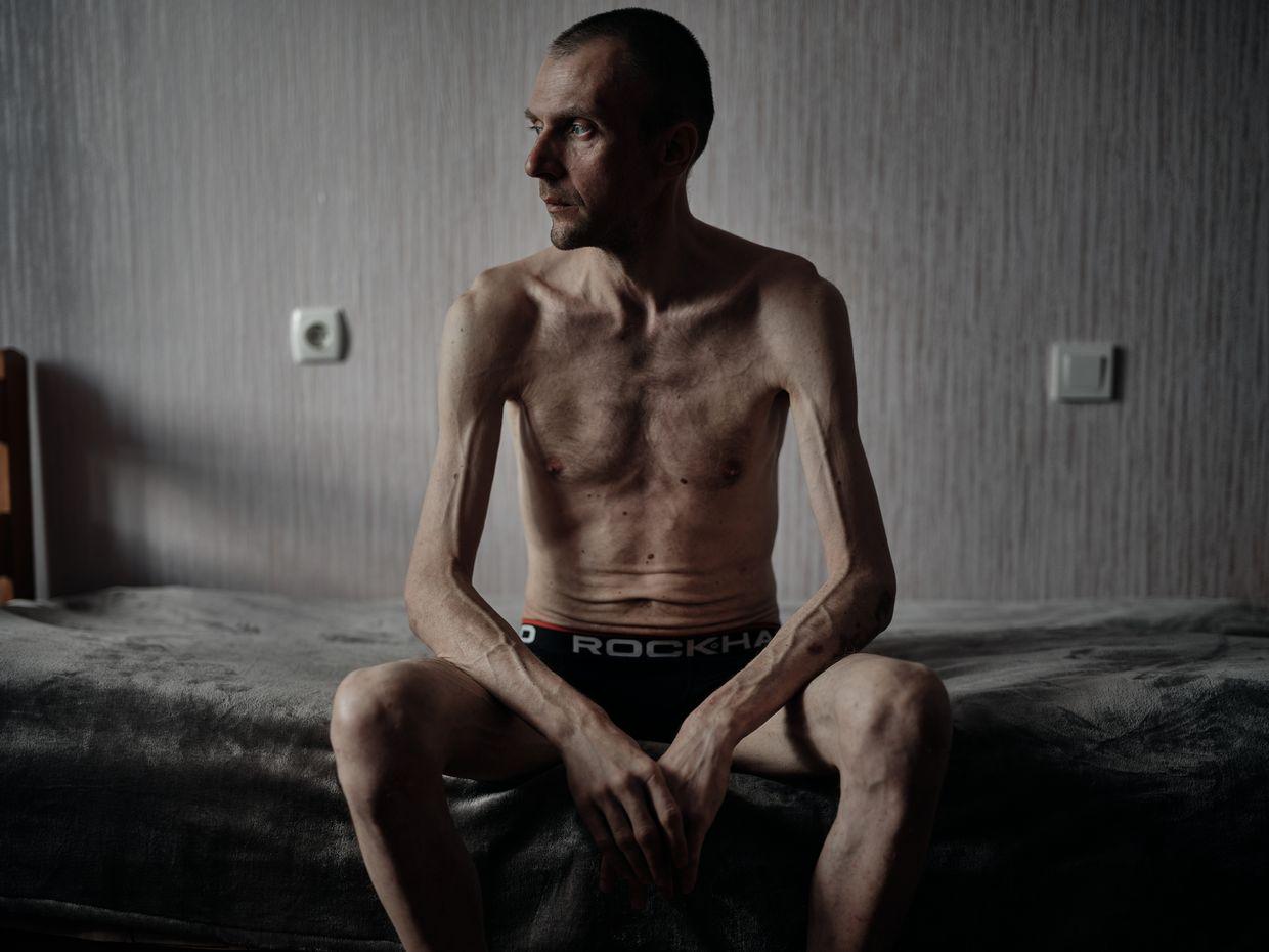 Years of torture, abuse in Russian captivity take shocking toll on Ukrainian POWs
