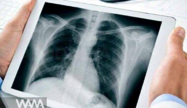 Iran Launches First Domestic Drug for Pulmonary Fibrosis