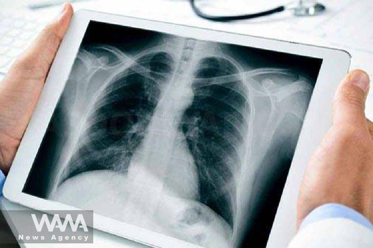 Iran Launches First Domestic Drug for Pulmonary Fibrosis
