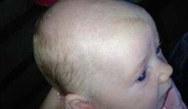 Yo les gars, je perds mes cheveux. C’est foutu?