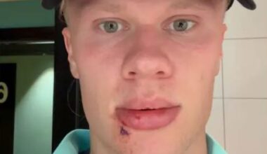 Haaland received three stitches after being hit by the door of the Norway national team bus