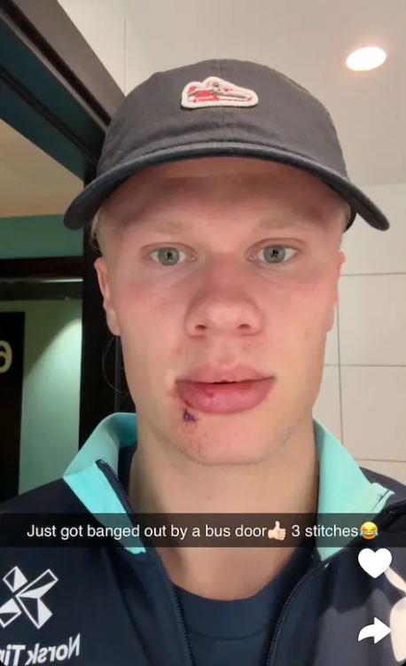 Haaland received three stitches after being hit by the door of the Norway national team bus