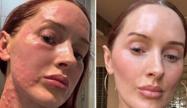 Women are flying to South Korea in droves for this painful beauty injectable