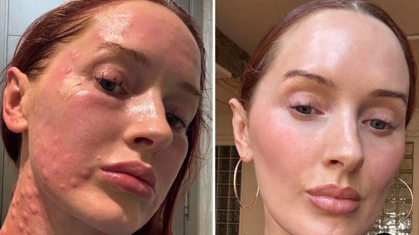 Women are flying to South Korea in droves for this painful beauty injectable
