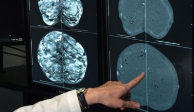 No, Switzerland didn't ban mammograms over radiation risks, false positives