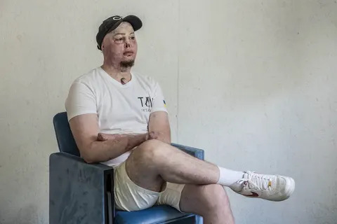 Yehor Babenko, 26, a war veteran and a psychologist, poses for a portrait in Kyiv, Ukraine on August 20, 2025. Yehor served in the State Border Guard Service of Ukraine and he was injured in March of 2022. His recovery after severe burns took a very long time and now he is helping other veterans with therapy.