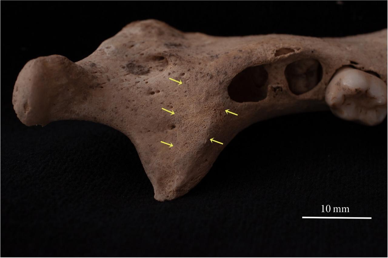 Close-up of periosteal thickening on the right mandible, showing remodelling activity in the jaw bone of the Middle Byzantine child from Aphrodisias. (Photo via Duru Yagmur Basaran/Childhood in the Past)