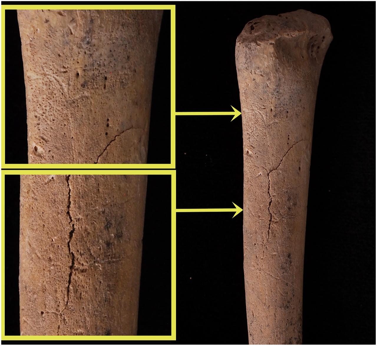 Remodelling periosteal new bone on the diaphysis of the left humerus, indicating inflammation and subsequent bone regeneration consistent with Caffey disease. (Photo via Duru Yagmur Basaran/Childhood in the Past)