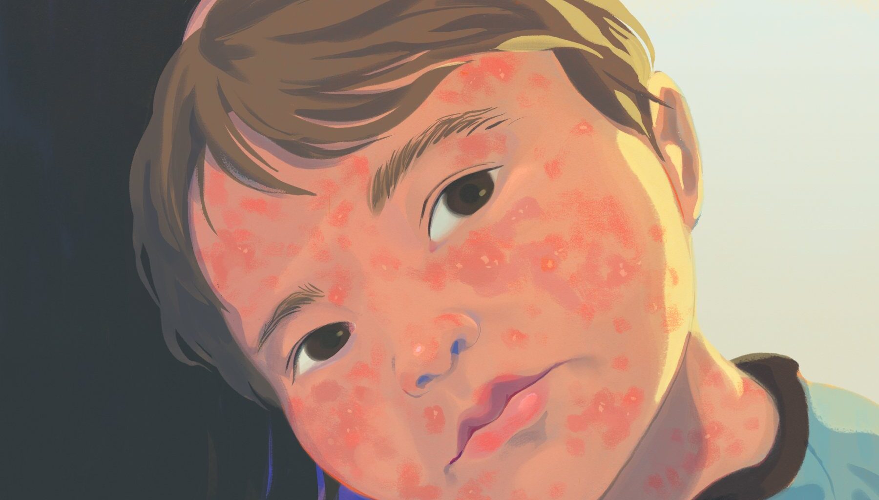 An illustration of a young boy, his face covered in measles, resting his head on his mother