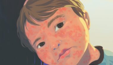 An illustration of a young boy, his face covered in measles, resting his head on his mother
