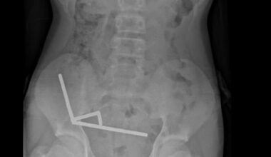 Teen boy swallows 80+ magnets, surgeons remove part of bowel