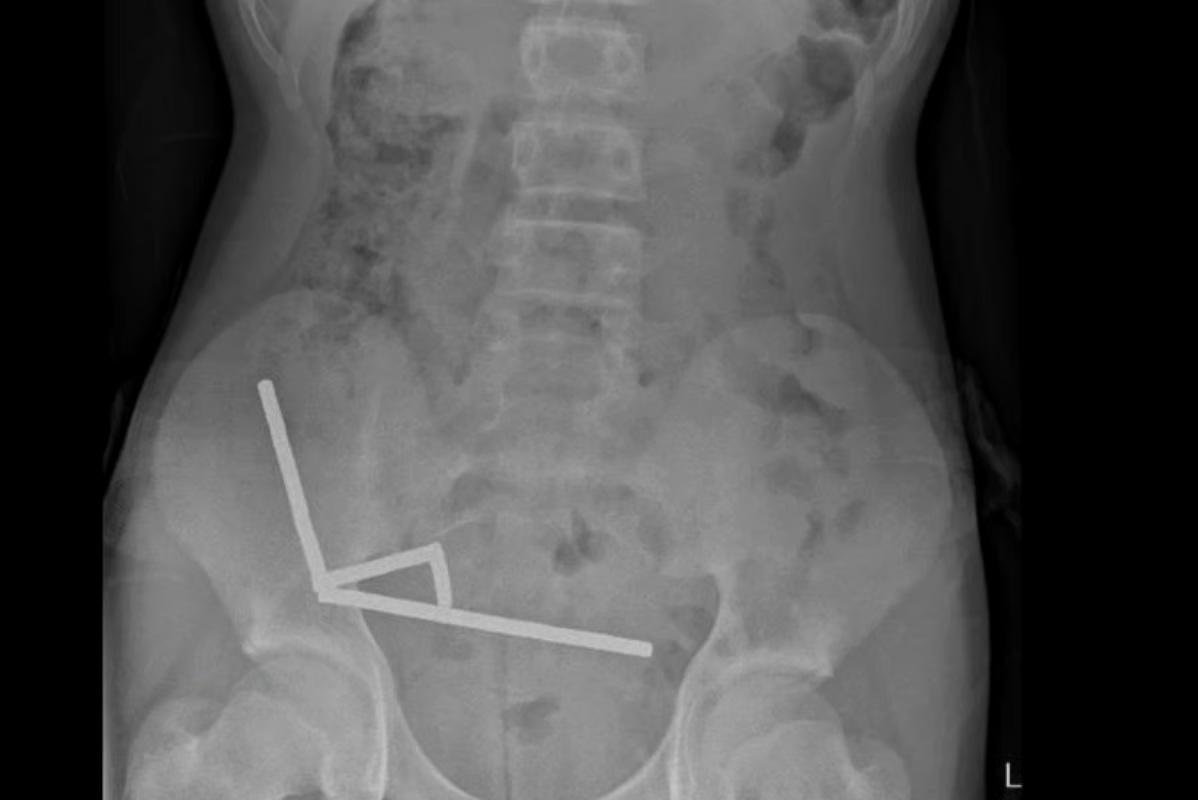 Teen boy swallows 80+ magnets, surgeons remove part of bowel