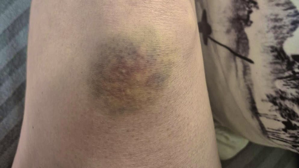 The Swiss woman suffered bruises after the incident.