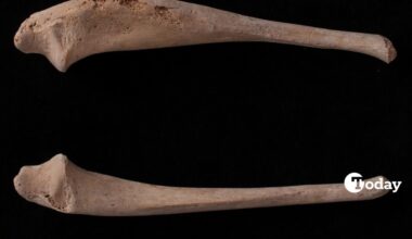 Comparison of the left and right ulnae showing the clear thickening of the left ulnar shaft, a key indicator of infantile cortical hyperostosis (Caffey disease). (Photo via Duru Yagmur Basaran/Childhood in the Past)