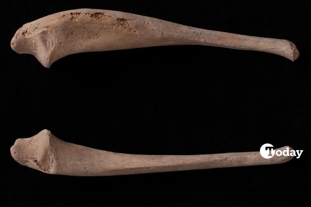 Comparison of the left and right ulnae showing the clear thickening of the left ulnar shaft, a key indicator of infantile cortical hyperostosis (Caffey disease). (Photo via Duru Yagmur Basaran/Childhood in the Past)