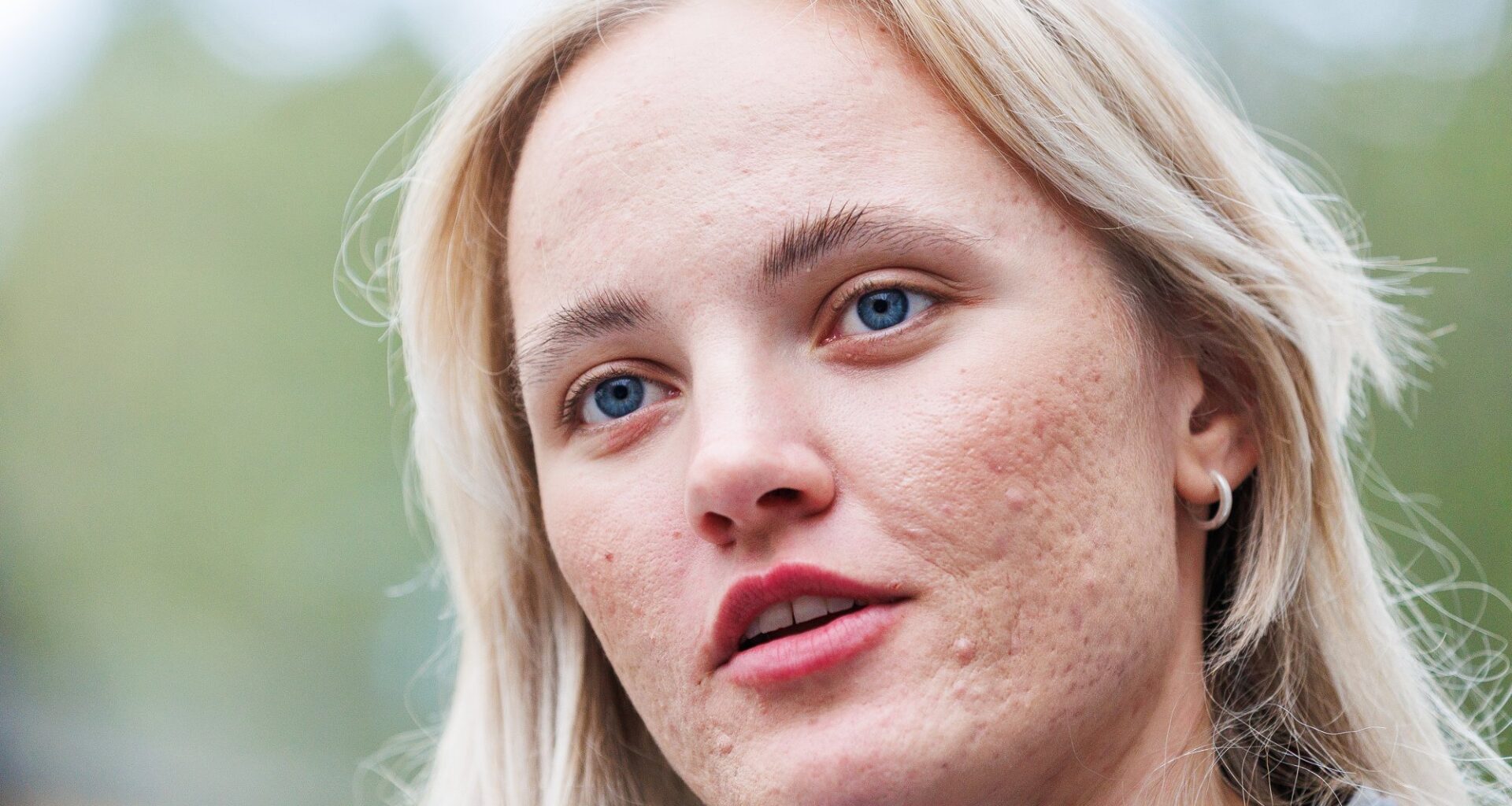 Linn Svahn, Langrenn | Linn Svahn ble rammet i Norge: – Orket ikke gå tur i fem minutter