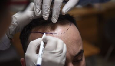 What makes this country a top destination for hair transplants : NPR