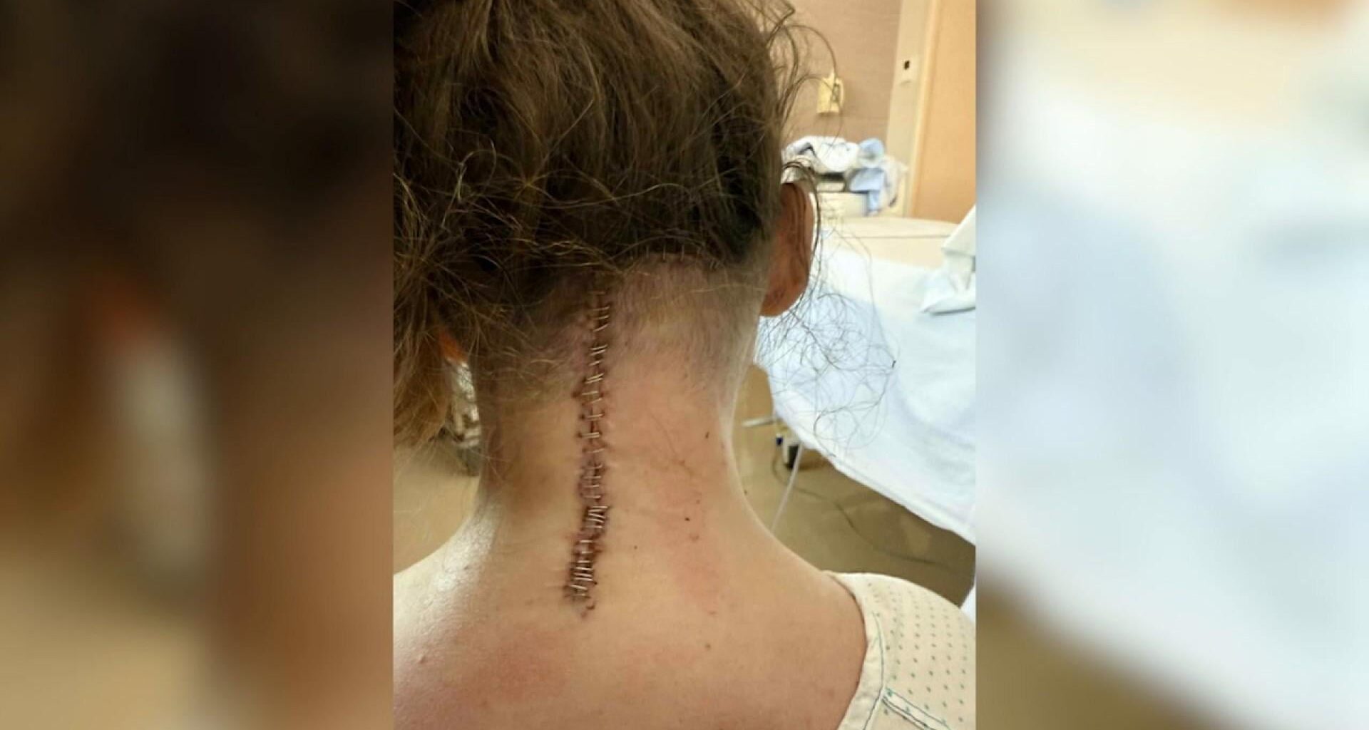 Christina fik ni måneder tilbage at leve i - nu er hun blevet opereret i Spanien for egen regning