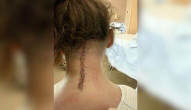 Christina fik ni måneder tilbage at leve i - nu er hun blevet opereret i Spanien for egen regning