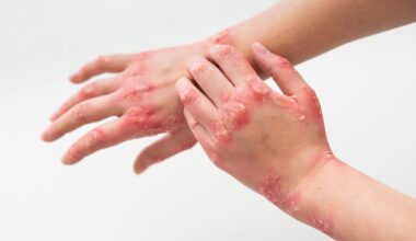 A Super Fungus Is Spreading Across UK: Brits Warned Over Serious Infection of Bum, Groin Area