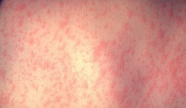 Israel reports second Tel Aviv doctor contracts measles