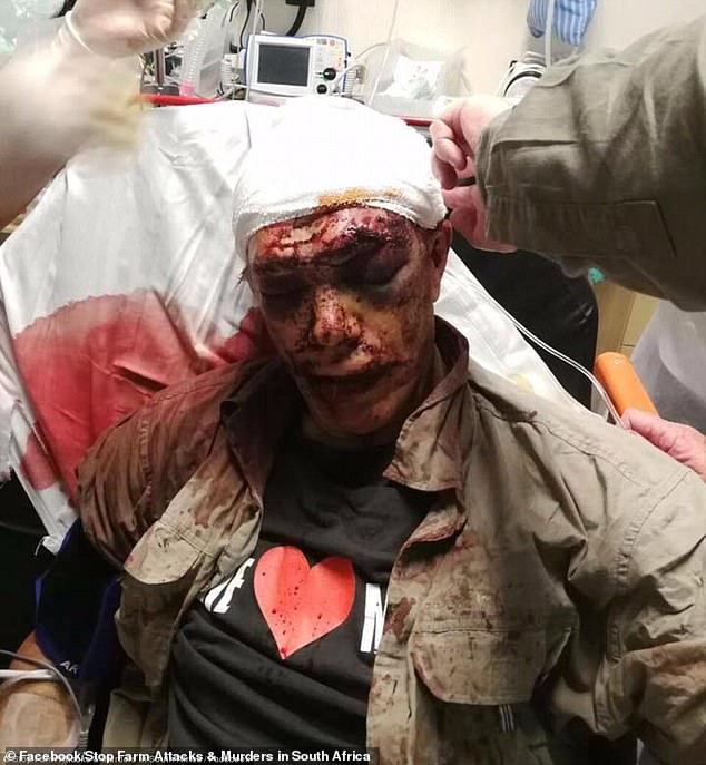Image shows a white South African's injuries following an alleged attack