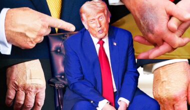 How Trump, 79, Turned Bruises and Cankles into Full-Scale Health Crisis