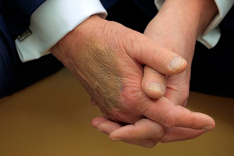 Makeup covers a bruise on the back of U.S. President Donald Trump's hand as he hosts French President Emmanuel Macron for meetings at the White House on February 24, 2025 in Washington, DC.