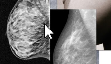De MRI om tumoren op te sporen bij hoge borstdichtheid is er nog niet. Dus zoeken vrouwen zelf naar screening